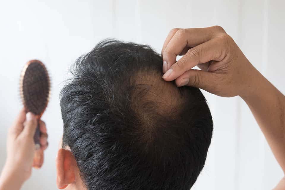 Problème de perte de cheveux chez l'homme | Santé au Masculin